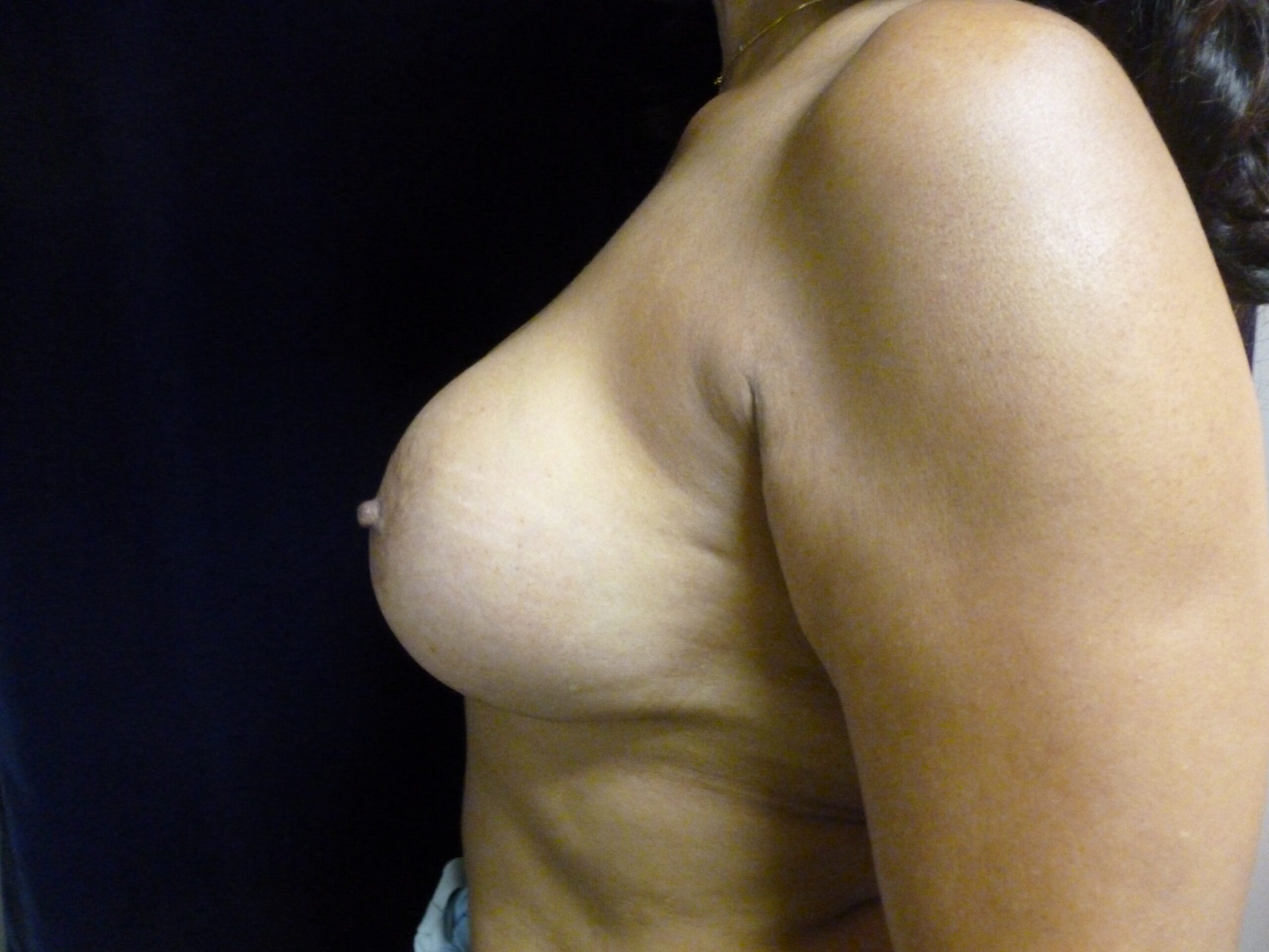 Breast Augmentation Patient Photo - Case 2010 - after view-3