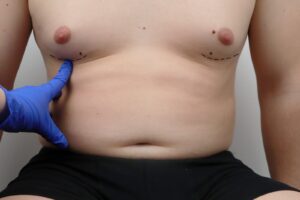 Prep for male breast reduction surgery | Green Hills Plastic Surgery