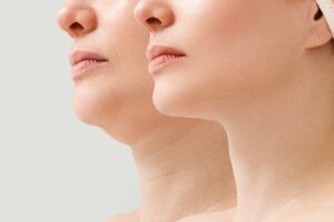 Before & after of neck lift plastic surgery | Green Hills Plastic Surgery